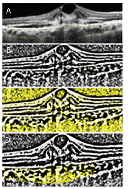 CVI calculation in a patient with exudative AMD. SD-OCT scans were imported into image J software and cropped. A) The area of choroid underneath the CNV was manually selected using the polygon selection tool and the area was saved. B, C, D) Image was then converted
