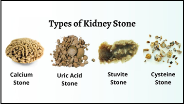 Different types of kidney stones (Image adopted from https://www.caresathome.com/blog/kidney-stone)