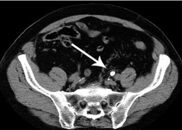 CT scan for kidney stones (Image adopted from https://fairbanksurology.com/test/ct-scan-for-kidney-stones)