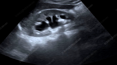 Kidney stone ultrasound scan. (Image adopted from https://www.sciencephoto.com/media/1216190/view/kidney-stone-ultrasound-scan)