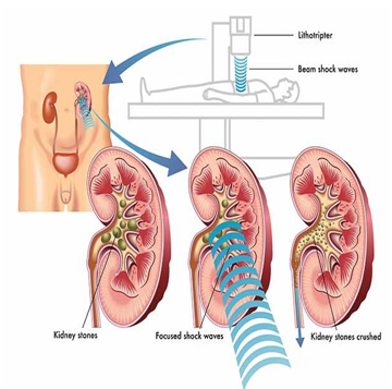 Extracorporeal shock wave lithotripsy (ESWL) Treatment for kidney stones (Image adopted from https://www.drvamsikrishna.com/services/kidney-stones-treatment/)