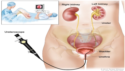 Ureteroscopy (Image adopted from https://www.niddk.nih.gov/health-information/diagnostic-tests/cystoscopy-ureteroscopy)