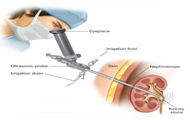 (PCNL) Percutaneous nephrolithotomy (image adopted from https://www.stgeorgeurology.com.au/percutaneous-nephrolithotomy-pcnl)