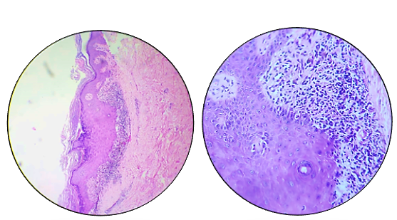 Lichen planus
