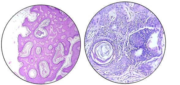 Seborrhoeic keratosis