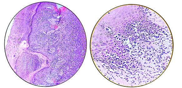 Malignant melanoma