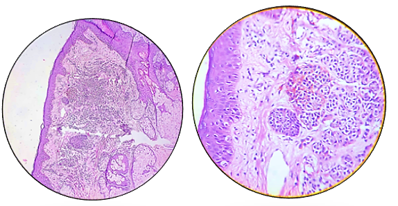 Melanocytic naevi