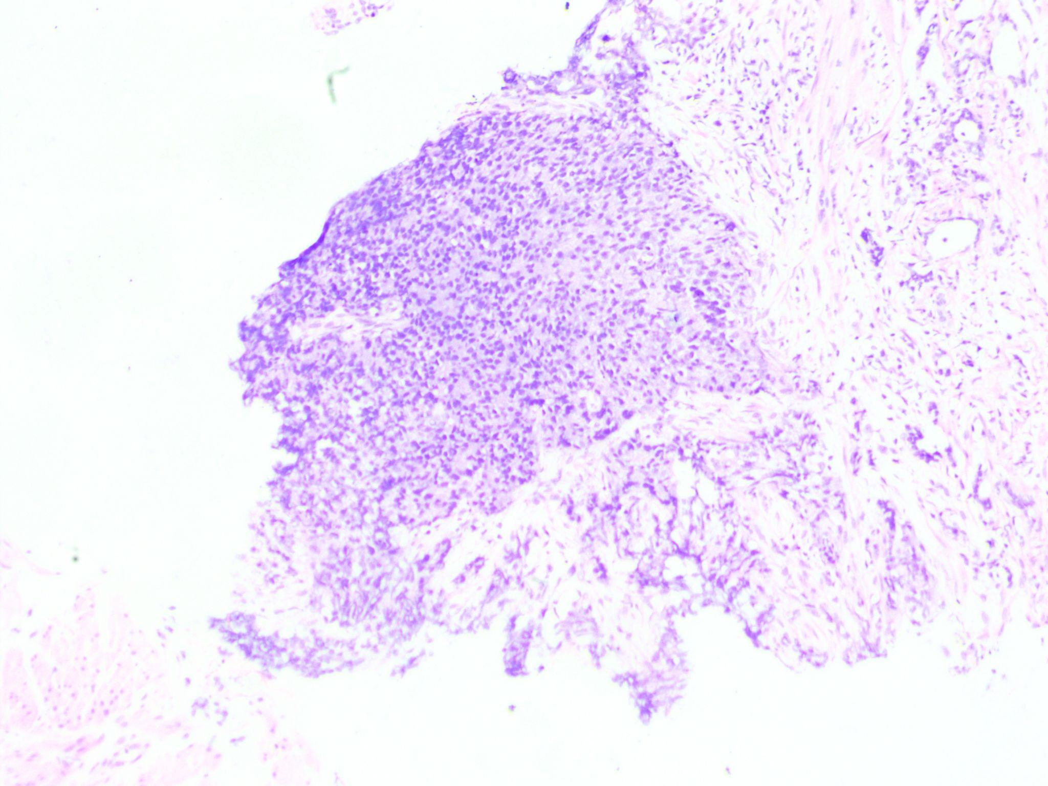H&E 10X view- Prostatic stroma infiltrated by tumour cells