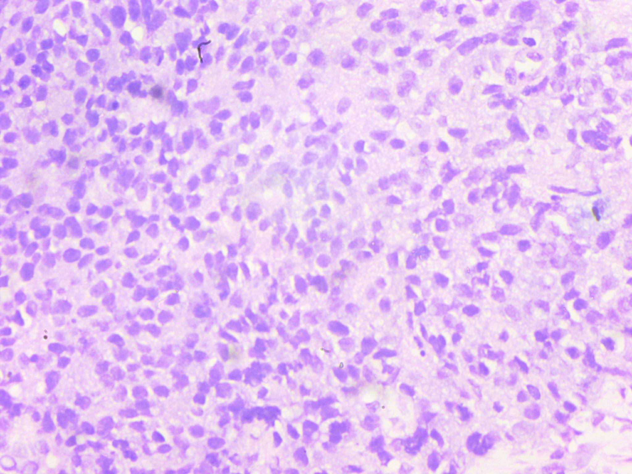 H&E 40X- Prostatic stroma infiltrated by tumour cells