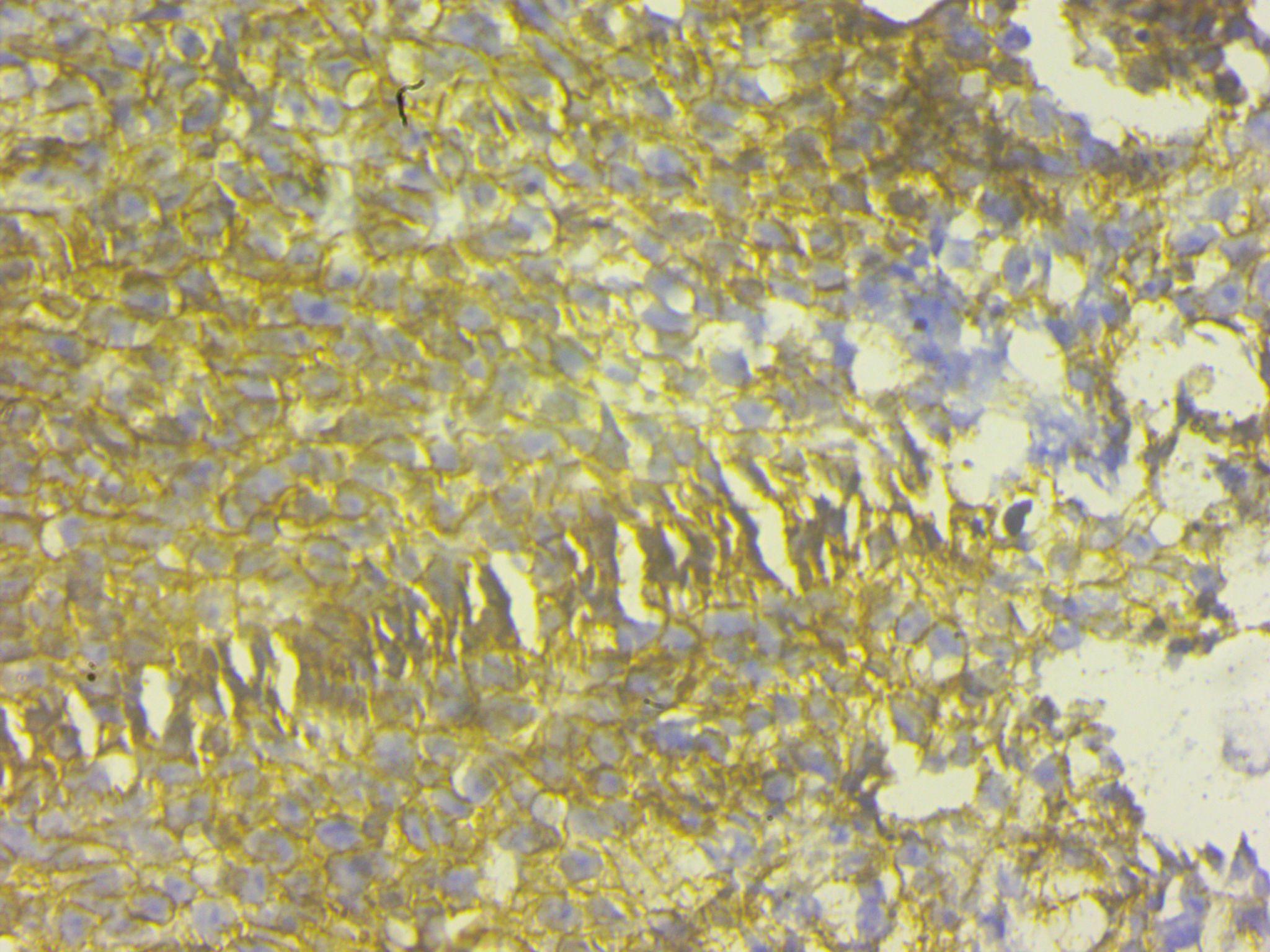 IHC- CD99 positive in tumour cells
