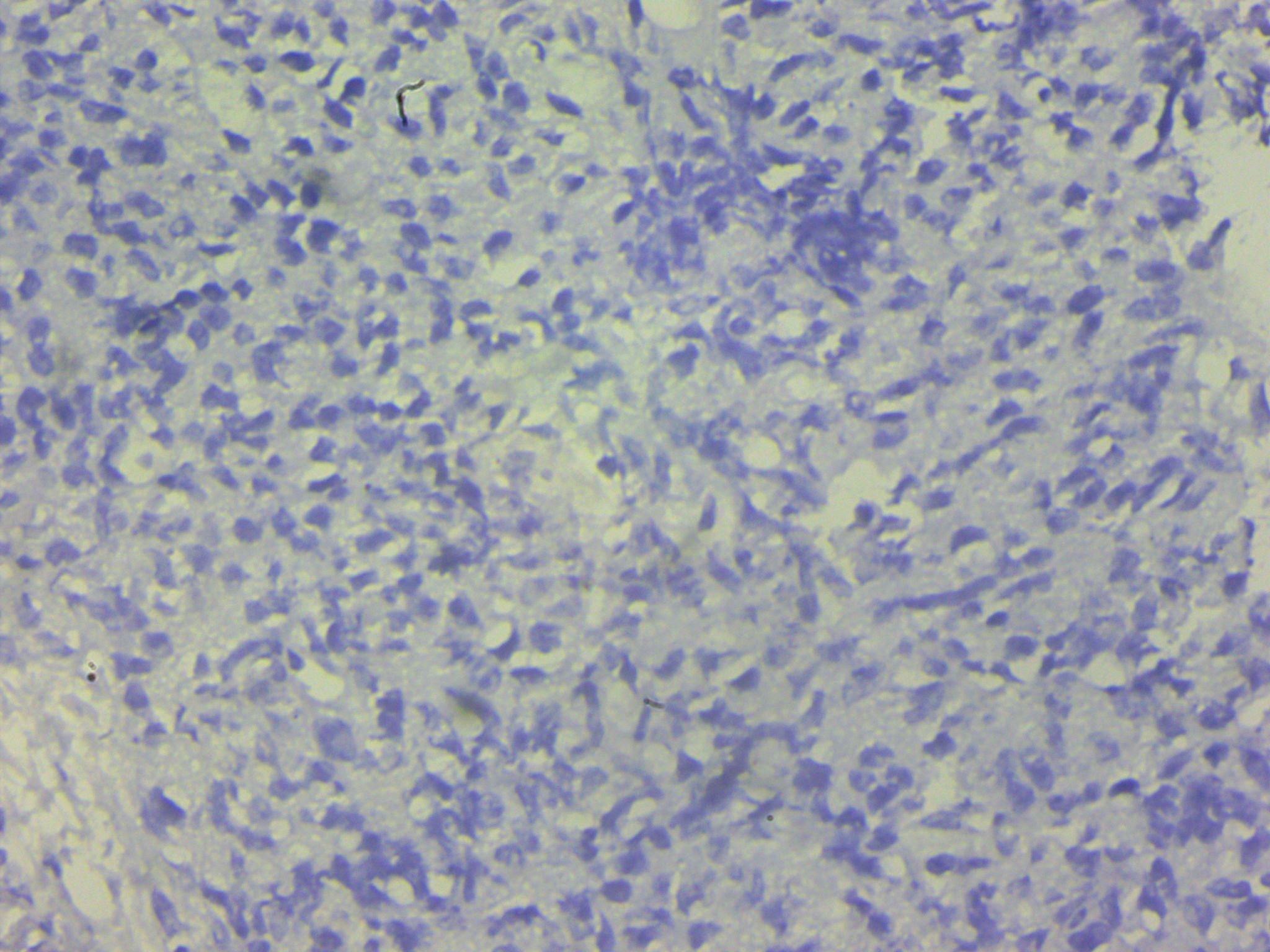 IHC- PSA negative in tumour cells