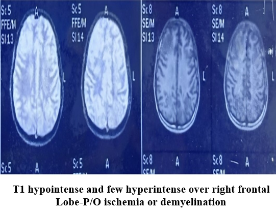 MRI brain