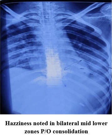 X-ray chest