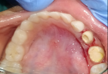 Zirconia crown tooth preparation irt 74, 75