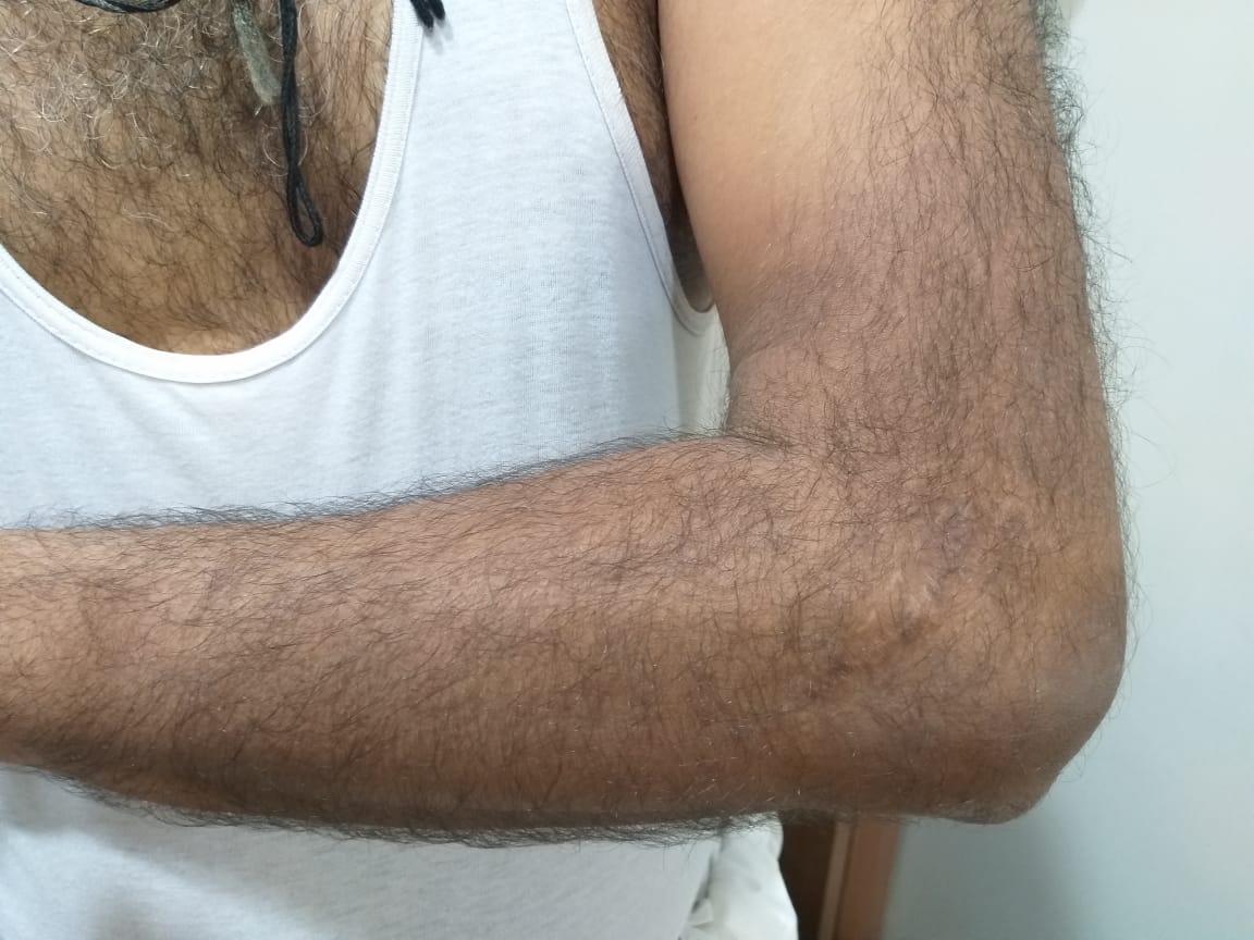 Healed scar of surgery on 11 years follow up
