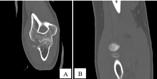 A,B: CT scan of left elbow after sustaining initial injury
