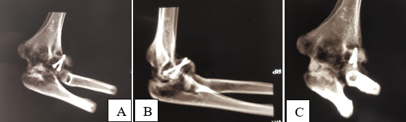 A, B and C: CT scans of left elbow done in March 2011