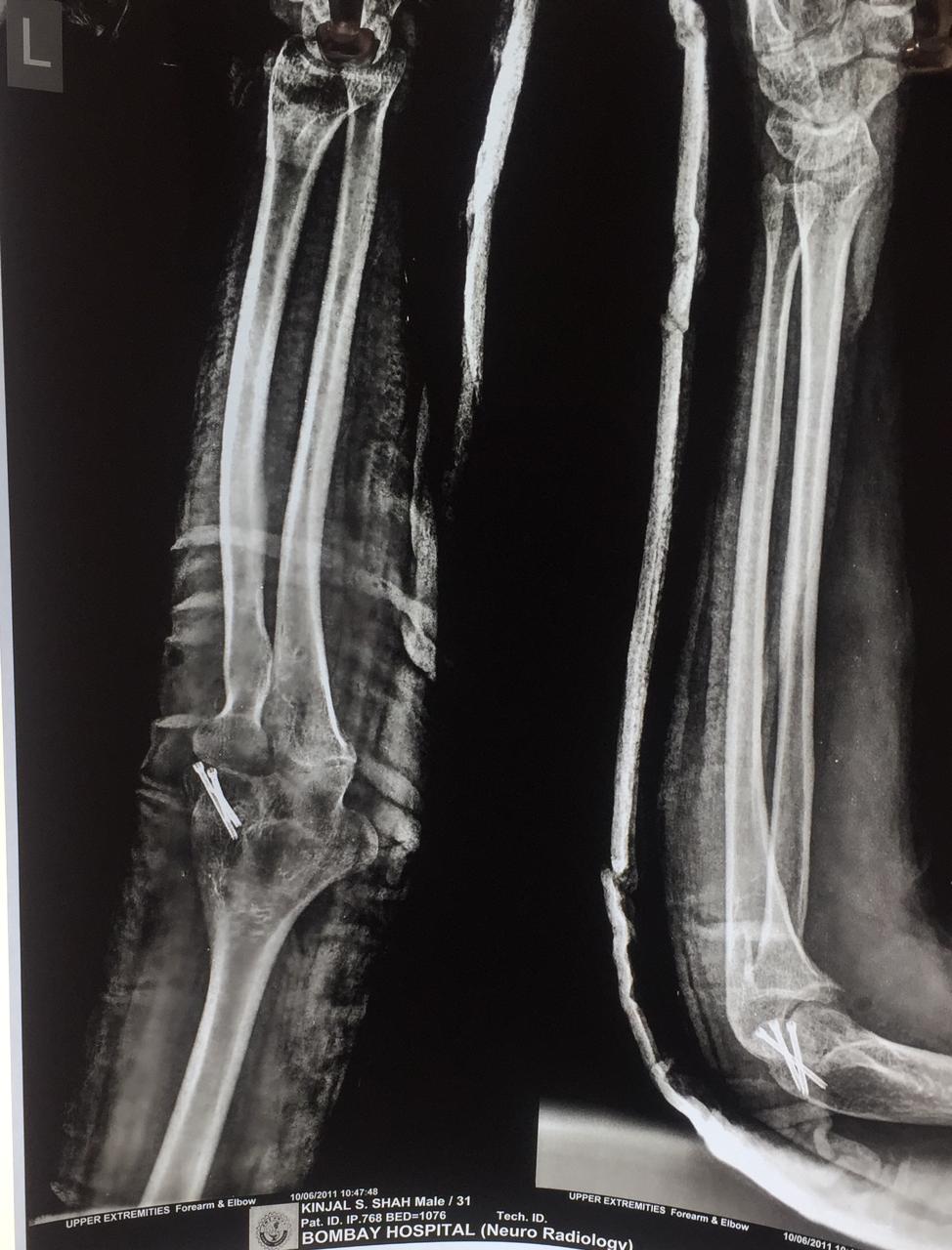 Immediate post operative, x-ray of left elbow following revision surgery in June 2011.
