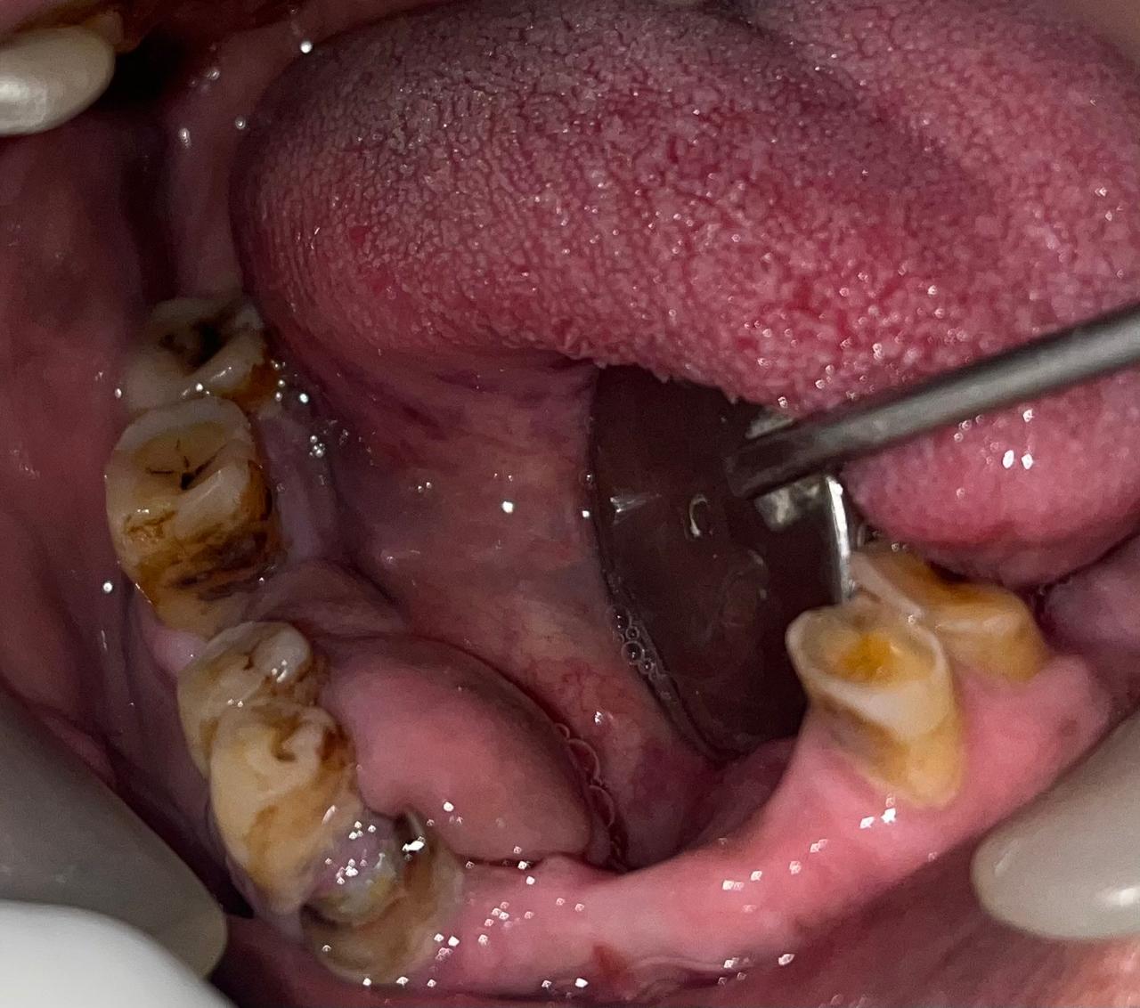 Pre-operative image of a large lesion