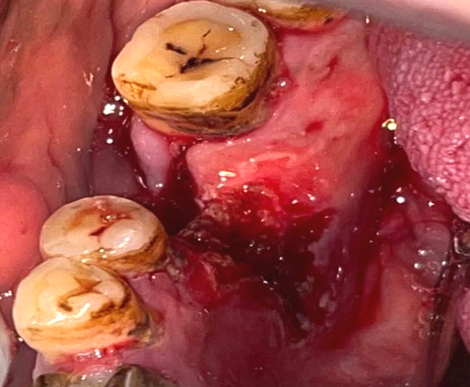 Image after excision of traumatic fibroma by laser