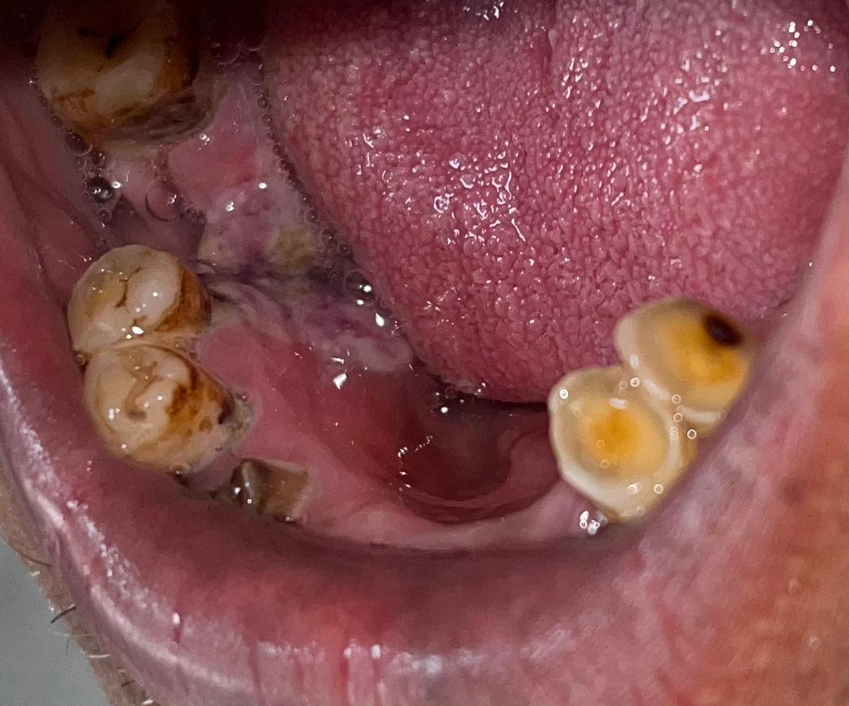 Follow-up after15 days showing initial healing