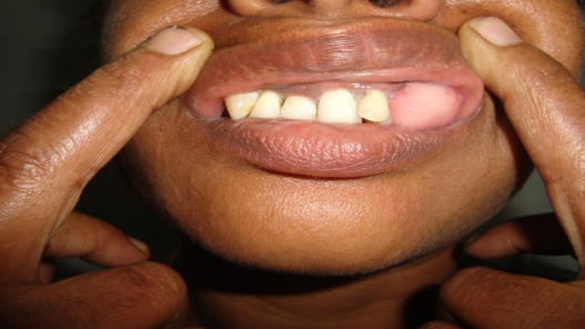 Epulis Benign Tumours.