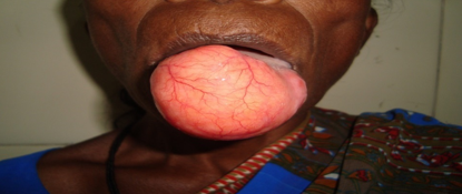 Largelipoma of tongue