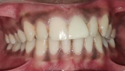 Final Zirconia crown cemented with 21