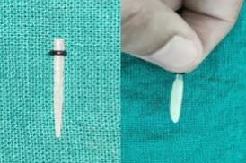 No. 4 glass fiber post & Composite resin adapted over fiber post