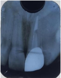 Post operative IOPA