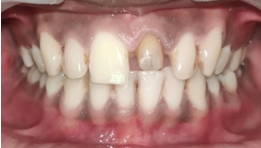 Anatomic post core cemented