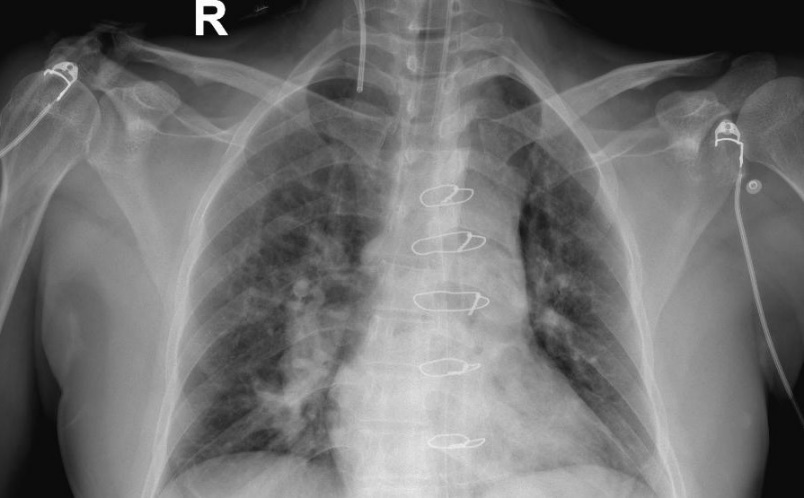 Chest radiograph showing higher placement of the CVC (central venous catheter)
