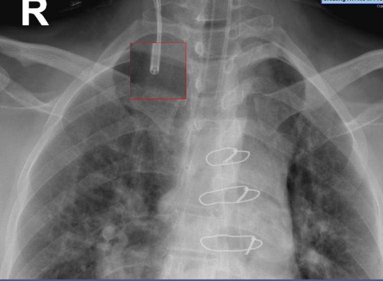 Zoomed view showing all lumens of the CVC