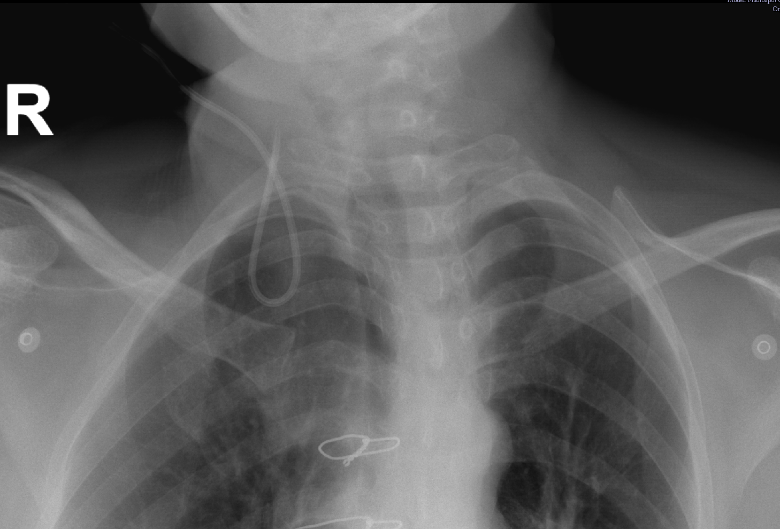 Chest radiograph showing looping of the CVC