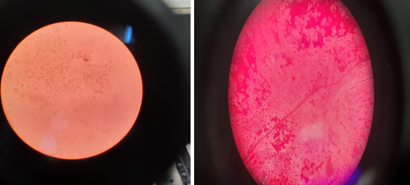 KOH mount showing hyaline septate hyphae and Trpysin with neutral red showing red colour fungal hyphae   