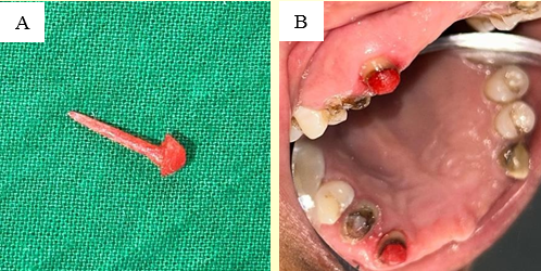 Post-space preparation using pattern resin; A: Impressions were taken using a pattern resin stick-assisted indirect technique; B: The fit of the impressions was assessed intraorally.
