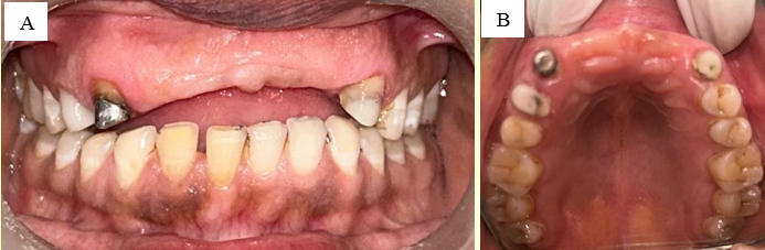 Custom-made cast post and core and fiber post core cemented intra-orally; A: Custom-made cast post fabricated with cobalt-chromium alloy for 13 and fiber post and core build up w.r.t 14 and 23; B: Ferrule preparation on the remaining coronal tooth structure and cemented cast post.
