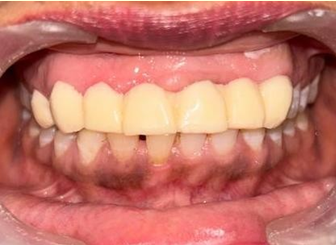 Porcelain-fused-to-metal crown cemented w.r.t 14, 13, 12, 11, 21, 22, 23