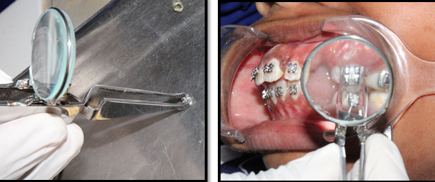Bracket positioning with modified bracket holder with magnifying lens.