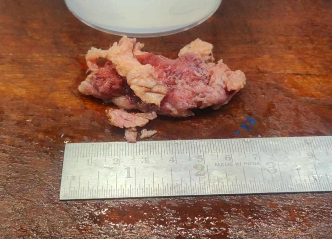 Gross picture of postauricular excised swelling