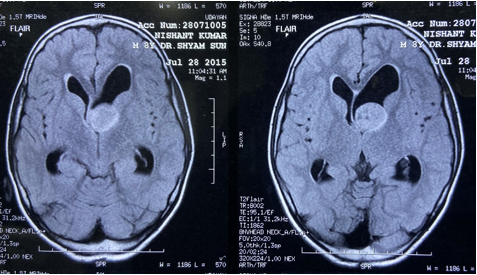 MRI Brain (July 2015) showing 2.2 x 2.1 x 2.0 cm sized lesion involving the left lateral frontal horn near the foramen of monro.