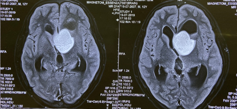 MRI Brain (July 2019) 3.5 x 3.0 x 2.8 cm sized centrally enhancing intracerebral SOL in the left anterior periventricular region and medial temporal lobe with compression of anterior third ventricle and left frontal horn with moderate obstructive hydrocephalus.