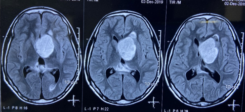 MRI Brain (December 2019) showing 4.6 x 3.6 x 4.4 cm sized well defined lesion seen along left lateral ventricle frontal horn near the foramen of monro.