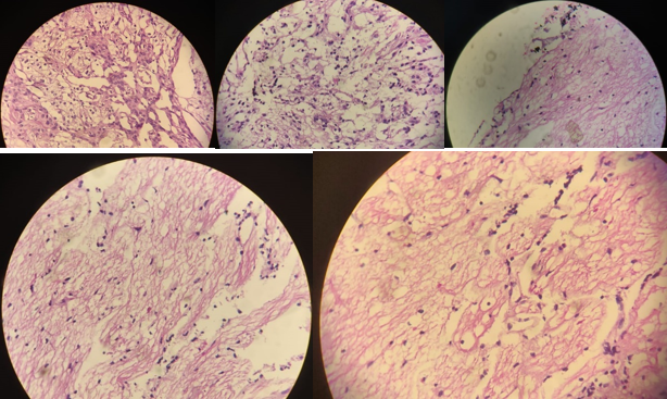(HE stained) Moderately cellular low grade glial tumor showing biphasic pattern comprising of bipolar cells and round to ovoid cells with fine chromatin. Also seen are Rosenthal fibres and rare eosinophilic granular bodies along with microvascular proliferation (Magnification – 400 x).