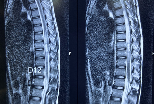 MRI spine screening (February 2020) showing intramedullary hyperintense lesion of size 6.6 x 7.4 x 20.9 mm in dorsal cord at D9-D10 level with adjoining edema, extending superiorly up to D7 level and inferiorly up to D11 level.
