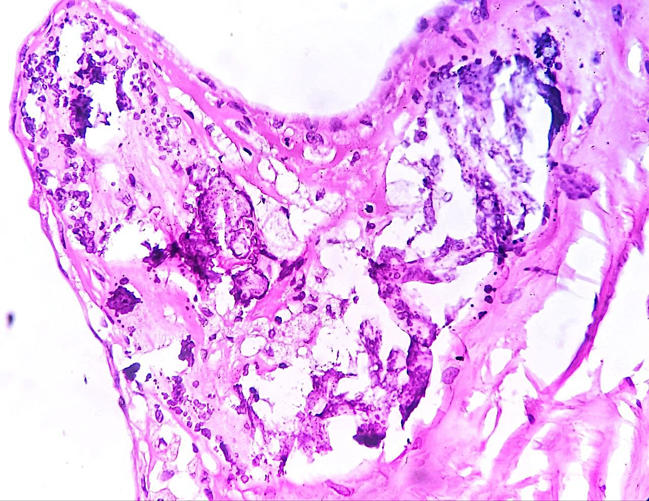 Foci of calcification within thyroid.