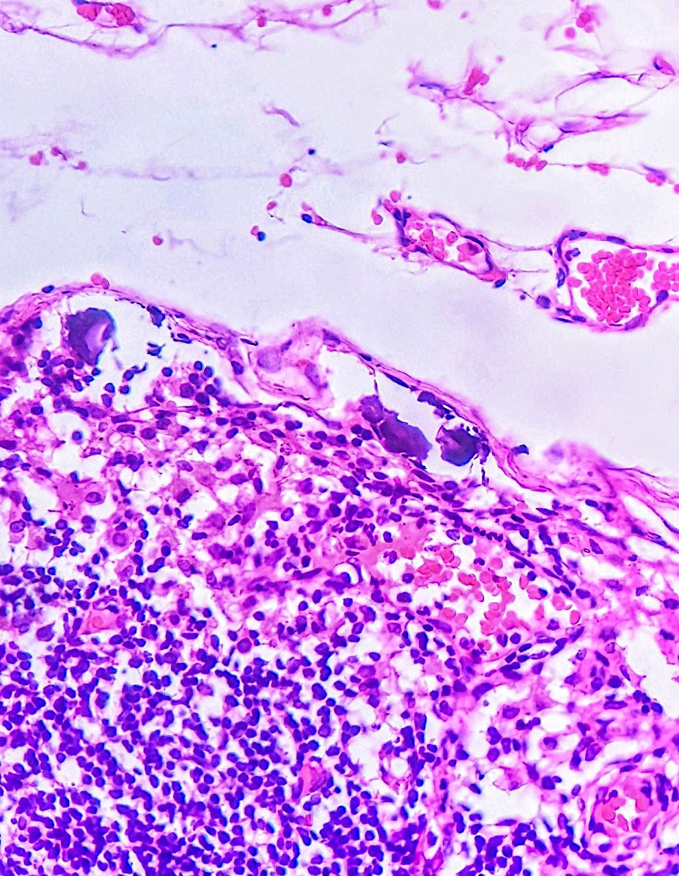 Psammoma bodies in subcapsular sinus of lymph nodes.