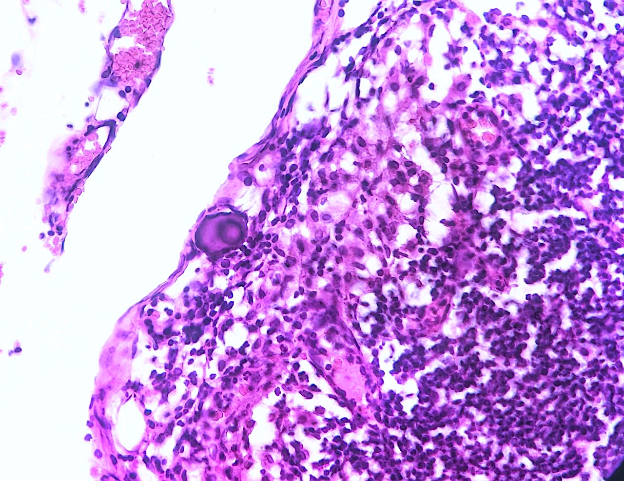 Psammoma bodies in subcapsular sinus of lymph nodes.