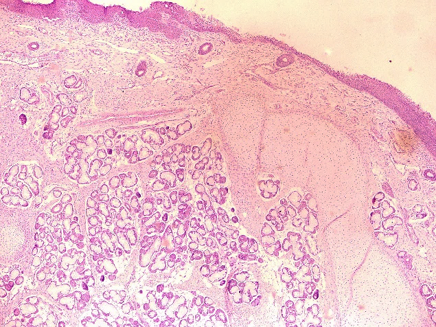H & E (10x) stained section shows epithelial lining, mucous glands and cartilage in case of laryngeal hamartoma