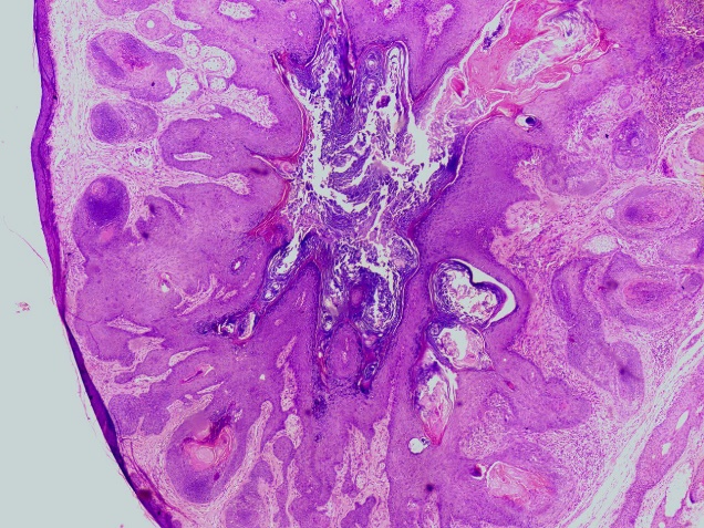 H & E (10x) stained section shows well differentiated radiating hair follicle at variable stage of maturation. And sebaceous gland in case of trichofolliculoma.